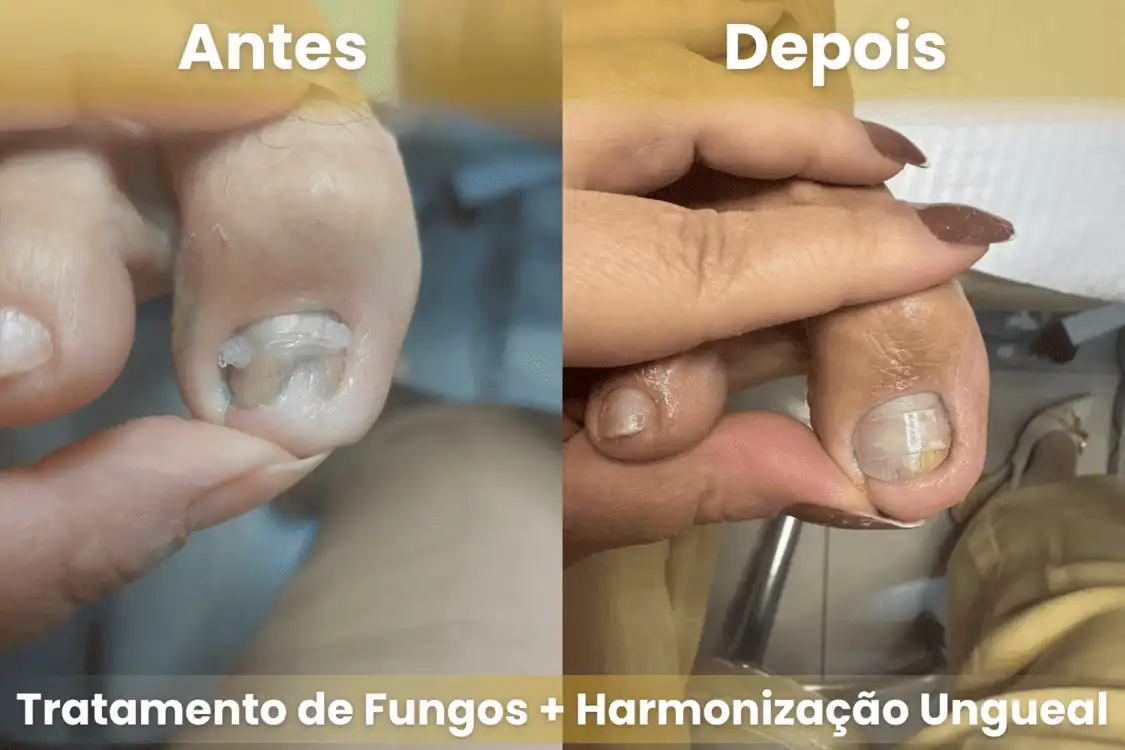Antes e depois de tratamento de fungos e harmonização ungueal